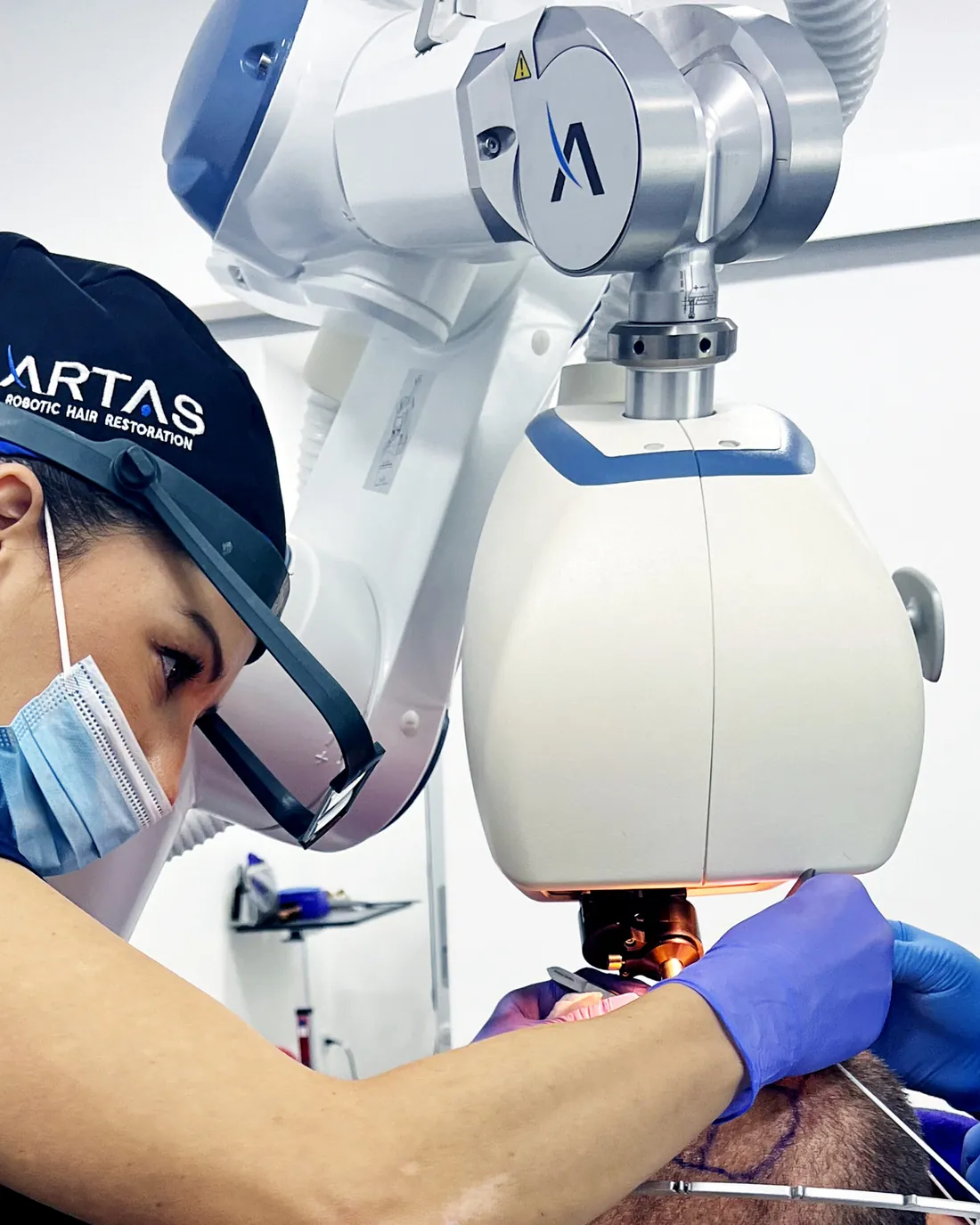 Robot ARTAS durante un trasplante capilar en La Clínica del Pelo