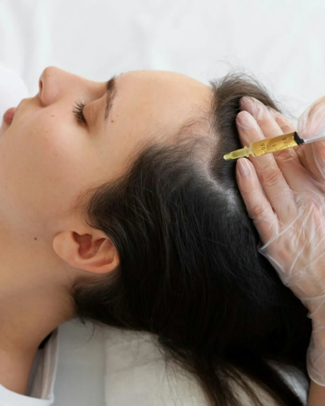 Aplicación de mesoterapia capilar en el cuero cabelludo